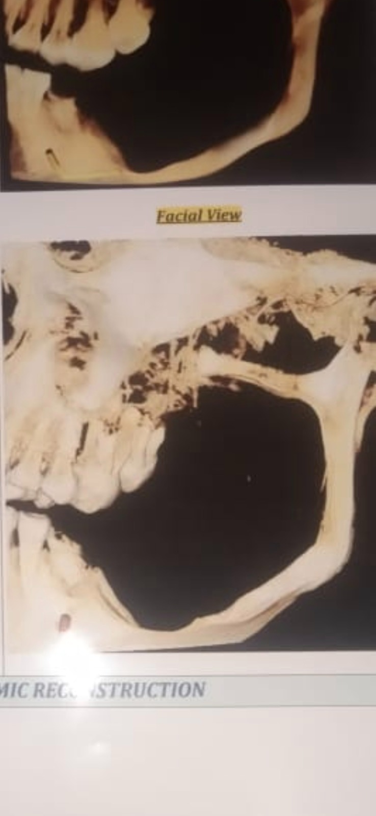 Large cyst/ Tumor on the Mandible