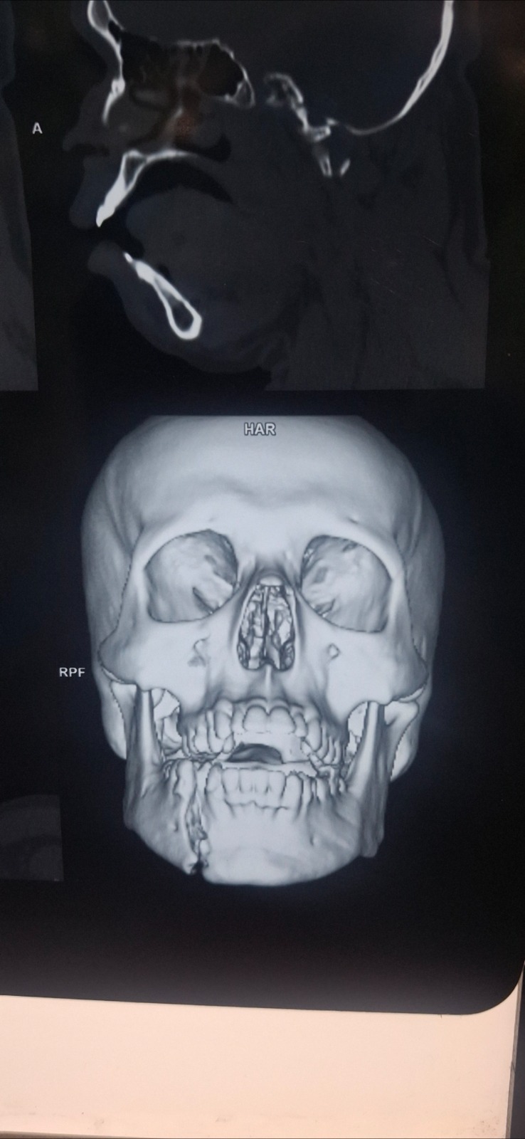 Mandible Fracture