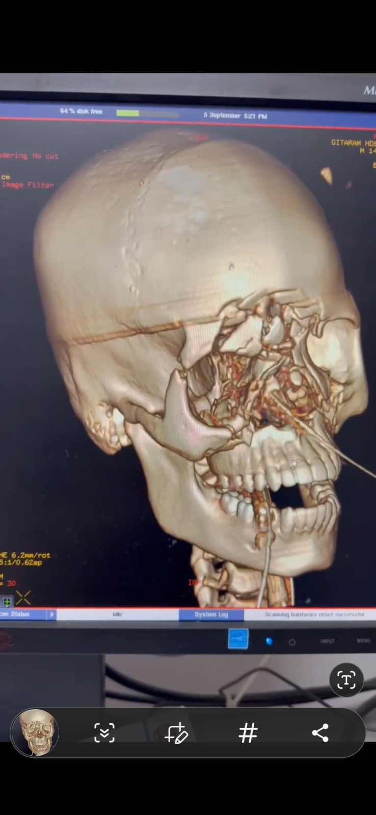 Panfacial Fracture