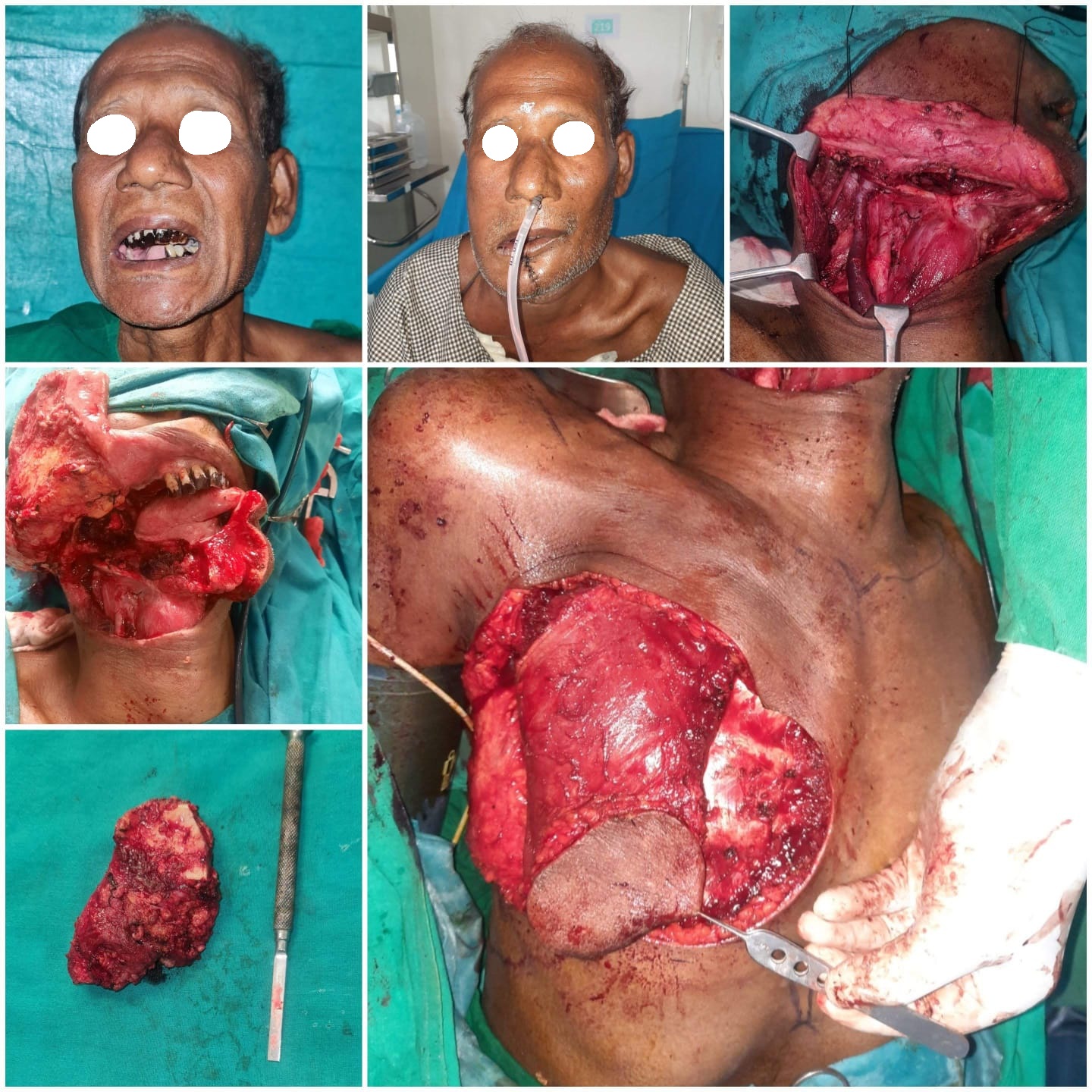 Oral cancer excision with Flap reconstruction