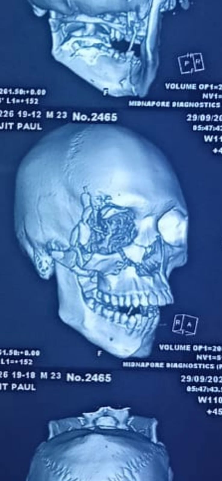 Zygomatic bone fracture