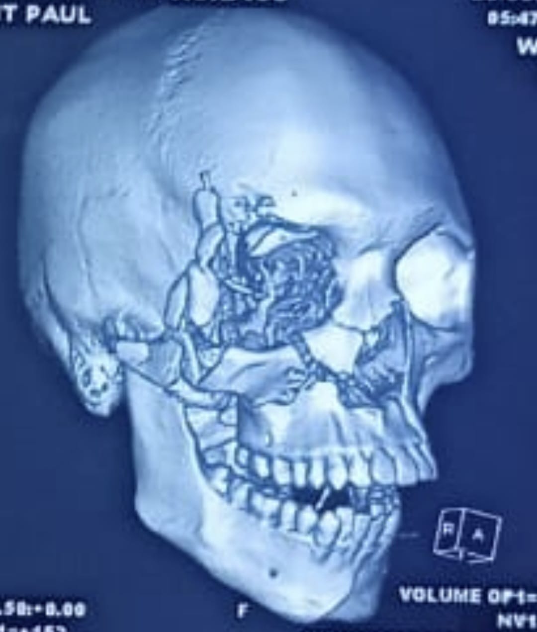Zygomatic bone fracture