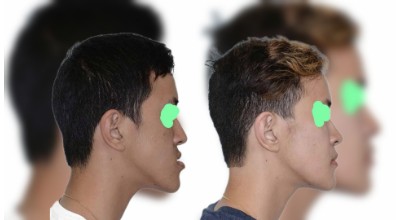 Orthognathic (Corrective Jaw) Surgery illustration