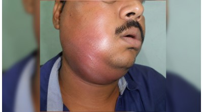 Management of Facial Infections illustration