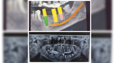 Tooth Implant Surgery & Full-Mouth Rehabilitation illustration